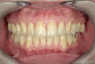 一般的な色のトーン